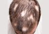 Alopecia Areata
