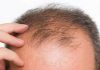 Minoxidil: Sim ou Não?