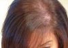 Meu cabelo teve uma queda e nunca mais foi o mesmo!