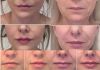 Harmonização facial sem exageros