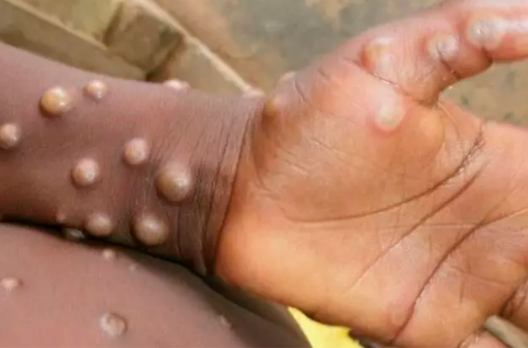 SC monitora varíola do macaco após 90 casos confirmados em ao menos 12 países
