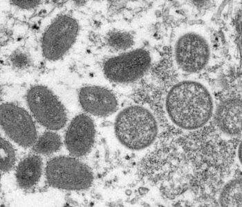 SC investiga dois casos suspeitos de varíola dos macacos; veja o que se sabe